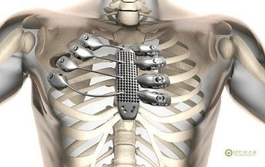 保加利亚患者接受第一次3D打印肋骨植入